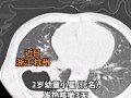 2歲娃總發燒咳嗽 一查肺里有個洞：8個月前嗑南瓜子 殼進入肺部